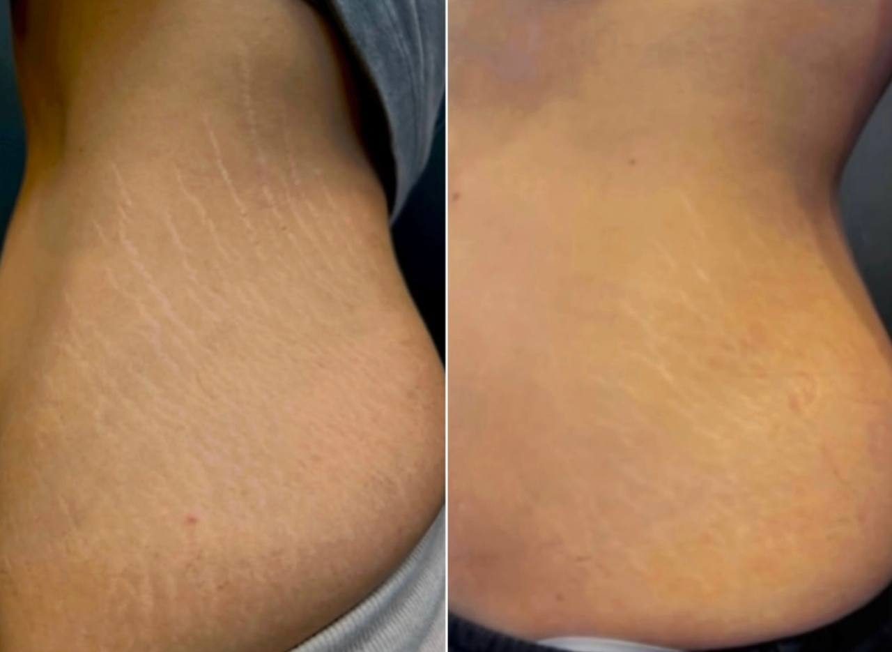 Blizny i rozstępy Szczecin — Salon Urody BAD ANGEL
