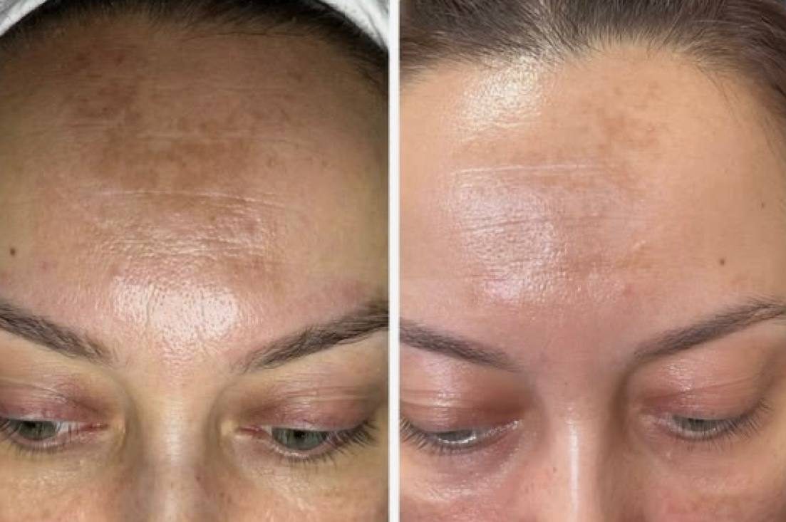 Blizny i rozstępy Szczecin — Salon Urody BAD ANGEL