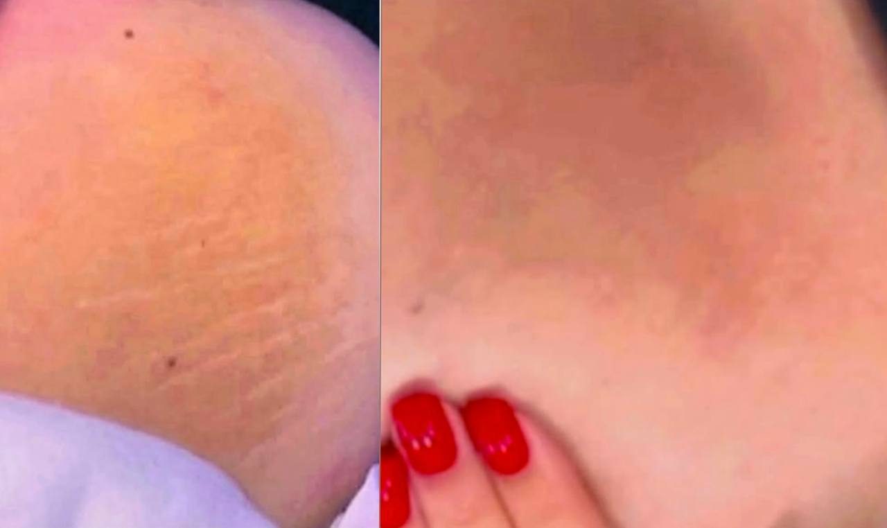 Blizny i rozstępy Szczecin — Salon Urody BAD ANGEL